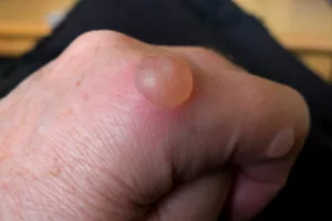 Water Blisters on Legs Pictures: Your Guide To Those Pesky Bubbles