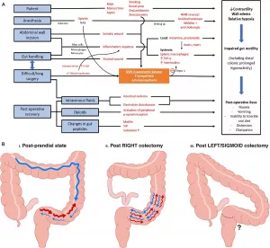 Weight Loss After Right Hemicolectomy: Real Talk on What to Expect Weight Loss After Right Hemicolectomy: Real Talk on What to Expect