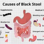 What Causes Dark Poop in Adults?