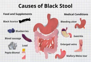 What Causes Dark Poop in Adults? Real Reasons & Everyday Stories