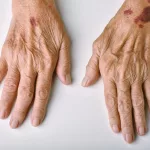 What Causes Purple Bruising in Elderly?