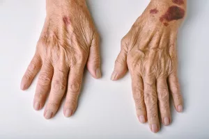 What Causes Purple Bruising in Elderly? A Real Talk About Those Surprising Spots