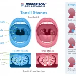What Do Tonsil Stones Look Like? Here’s the Real Deal