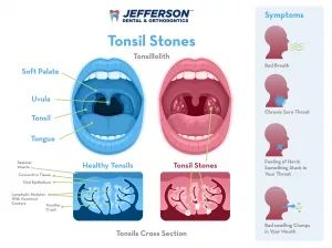 What Do Tonsil Stones Look Like? Here’s the Real Deal