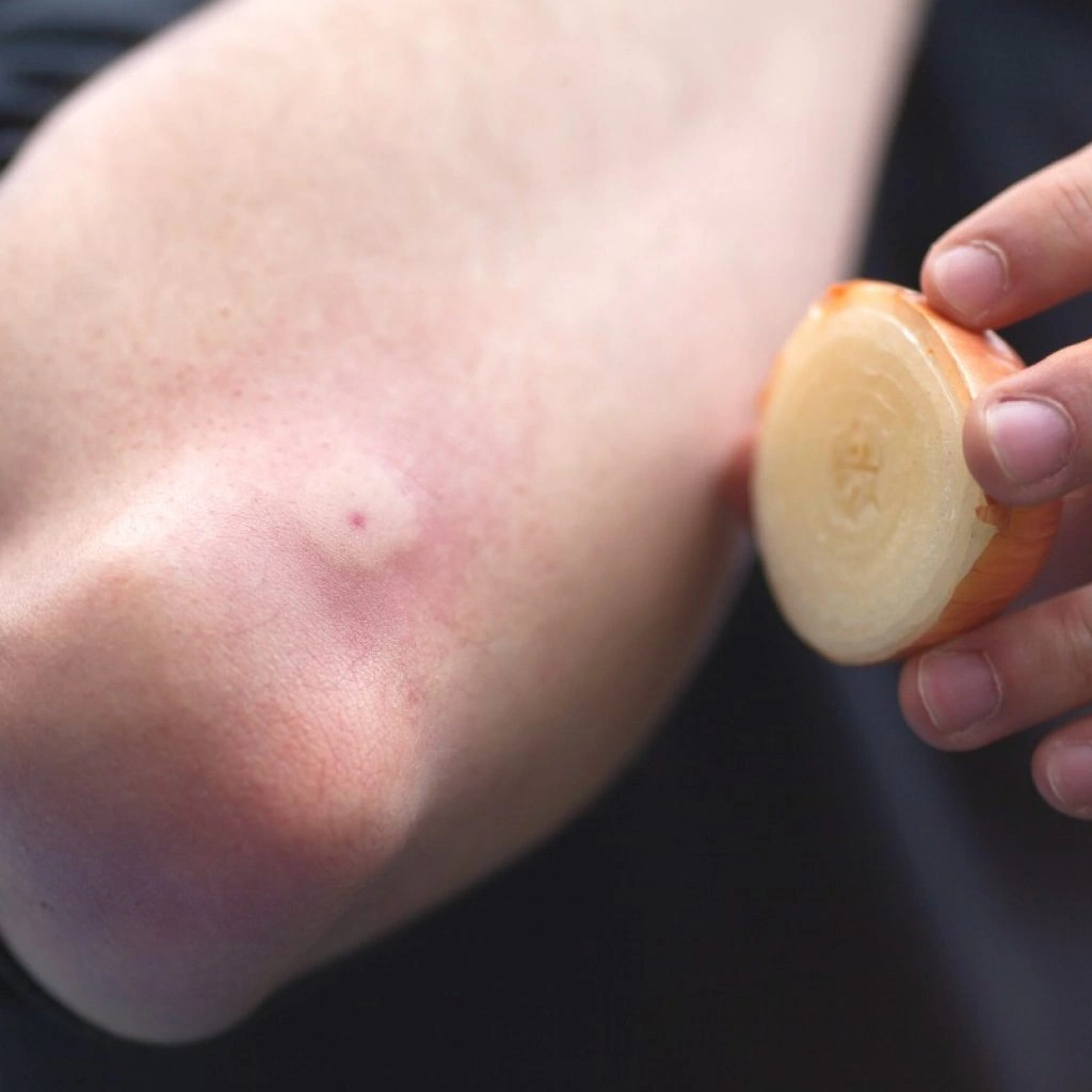 What Does a Bee Sting Look Like? Let’s Get Real (And a Little Itchy)