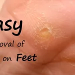 What Does a Corn Look Like After Removed?