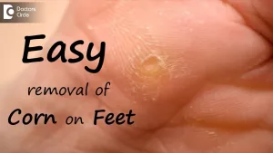 What Does a Corn Look Like After Removed? (And What Nobody Tells You About The Healing)