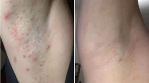 What Does Armpit Razorburn Look Like? (So You Don’t Freak Out) What Does Armpit Razorburn Look Like? (So You Don’t Freak Out)