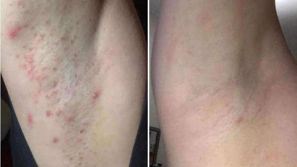 What Does Armpit Razorburn Look Like? (So You Don’t Freak Out)