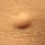 When to Worry About a Lump Under Skin