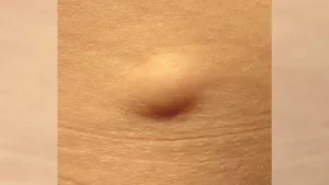 When to Worry About a Lump Under Skin: The Human Guide