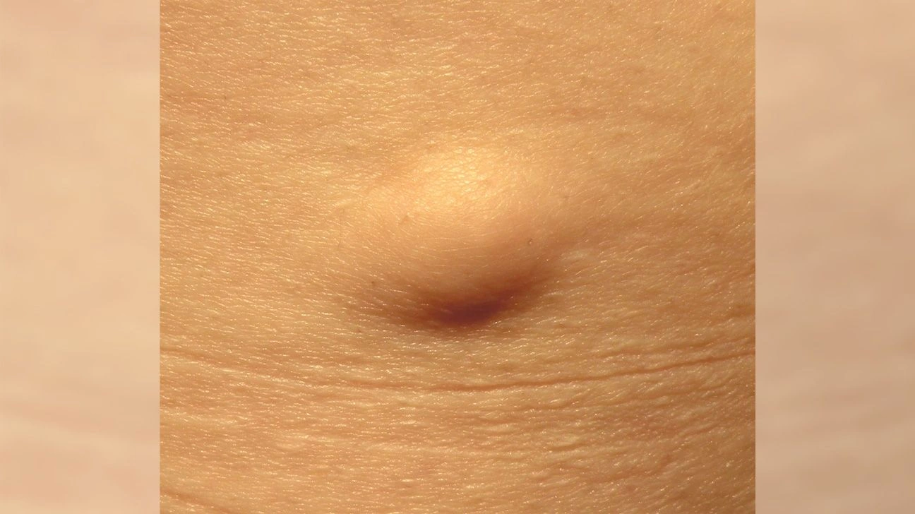 When to Worry About a Lump Under Skin: The Human Guide