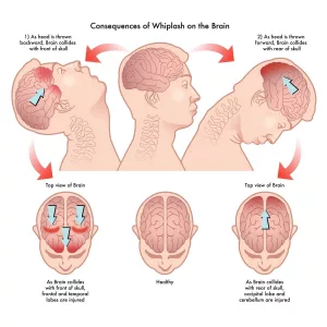 Whiplash Nerve Damage Symptoms: Everyday Clues You Shouldn’t Ignore