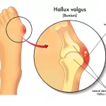 Why Does My Big Toe Go Inward for a?