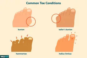 Why Is My Big Toe Bent Sideways? The Truth Behind the Sneaky Foot Shift