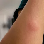 Why Bug Bites Bruise After Hydrocortisone