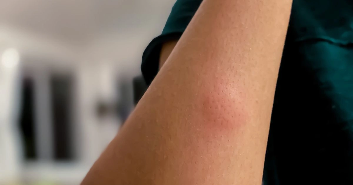 Why Would a Bug Bite Turn Into a Bruise After Applying Hydrocortisone Cream?