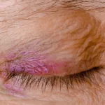 Woke Up with Bruised Eyelid: Causes & Tips