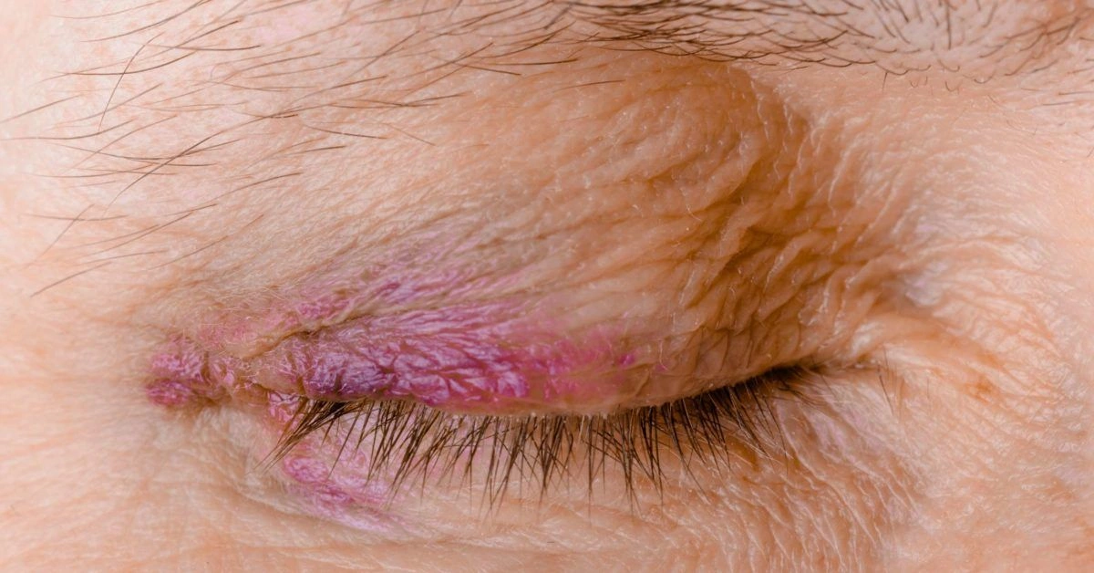 Woke Up with BRUISED Eyelid: When Your Morning Mirror Surprises You