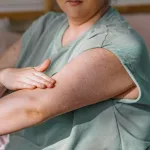 Itchy Mole and Melanoma: What Your Itch Might Reveal