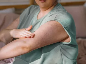 Itchy Mole and Melanoma: What Your Itch Might Reveal