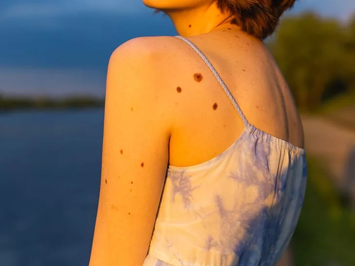 Freckles vs Moles: Easy Guide to Spot the Difference