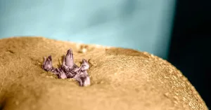 Anal Skin Tag: Recognition & Treatment