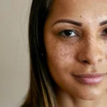 Anicteric Sclerae: Normal White of the Eye