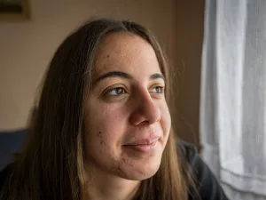 Everything You Want to Know About Laser Treatment for Acne Scars