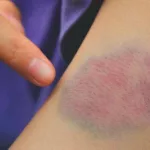 Is It a Blood Clot or a Bruise?