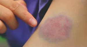 Is It a Blood Clot or a Bruise?