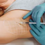 Everything You Need to Know About Botox for Sweating