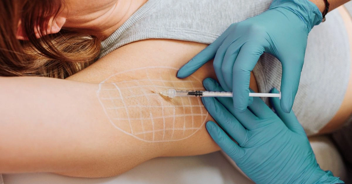 Everything You Need to Know About Botox for Sweating