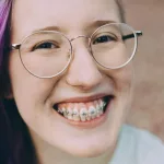 Braces Stains: Causes and Treatments