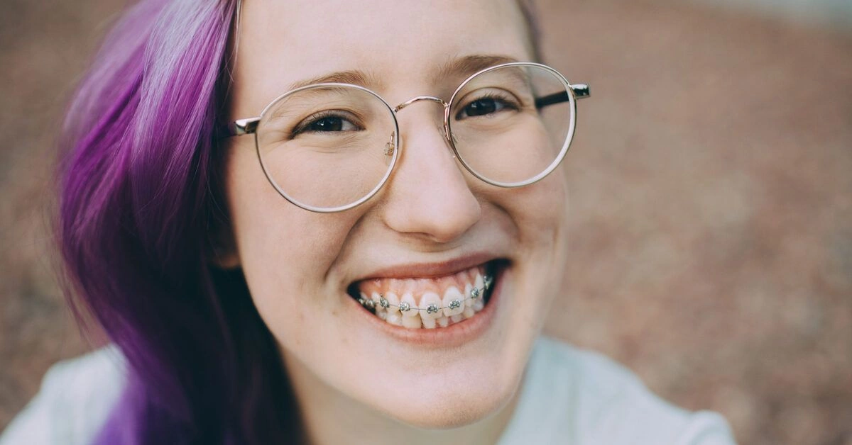 Is Dental Discoloration Caused by Braces Permanent?