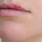 Bumps on Lips