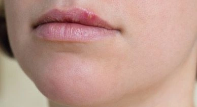 Bumps on Lips