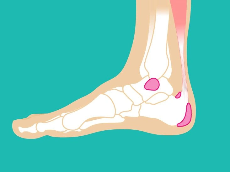 About Ankle Bursitis: What It Is and What to Do