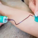 Butterfly Needle Guide for Patients