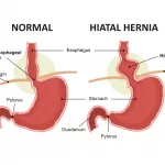 Best Comfortable Bras for Hiatal Hernia