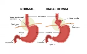 Finding Comfortable Bras for Hiatal Hernia: What Actually Works? Finding Comfortable Bras for Hiatal Hernia: What Actually Works?