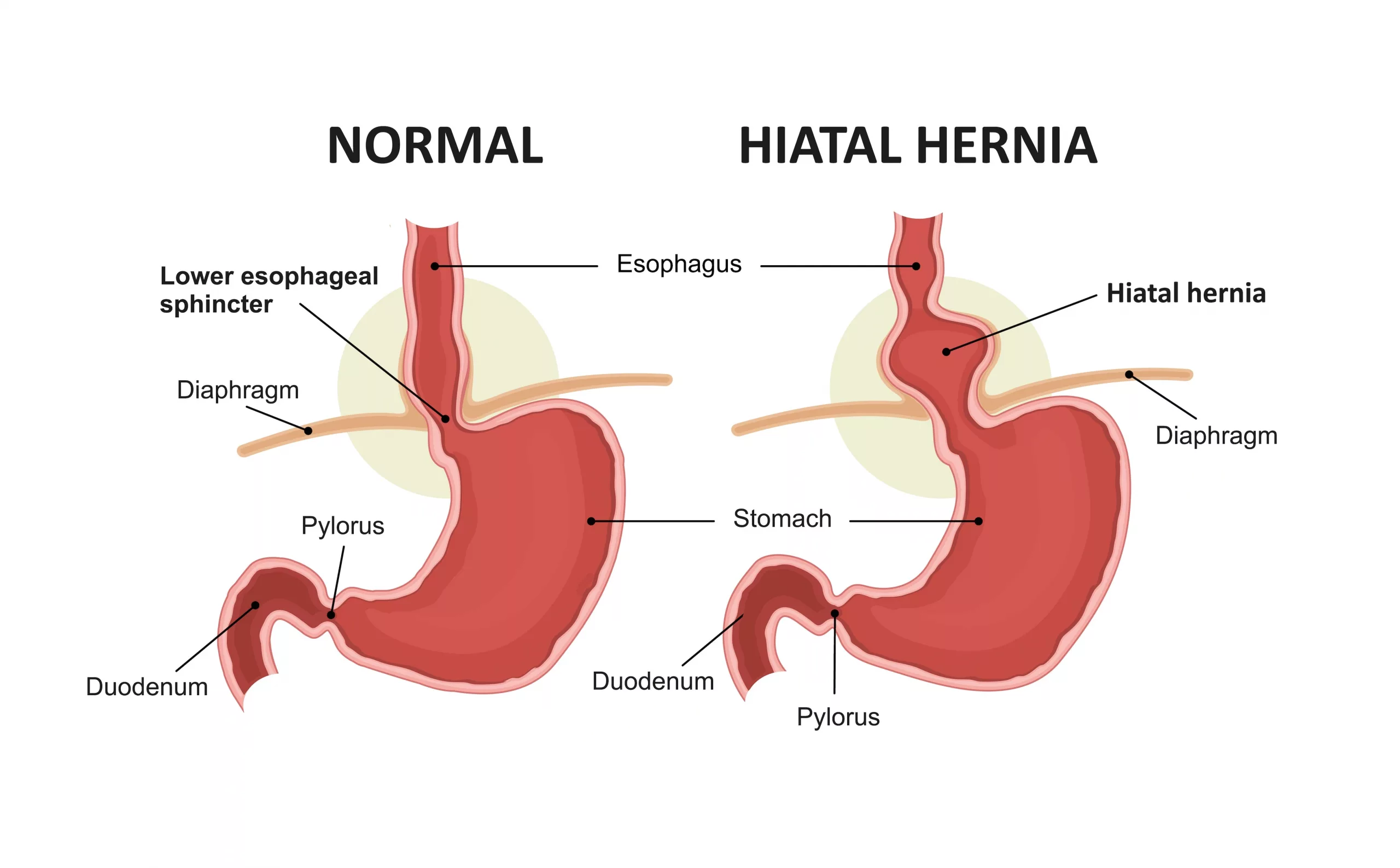 Finding Comfortable Bras for Hiatal Hernia: What Actually Works?
