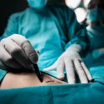 Coolsculpting Vs Liposuction: Which Is Best?