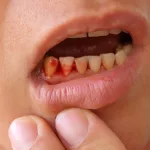 Cut On Gums: Identification & Quick Care