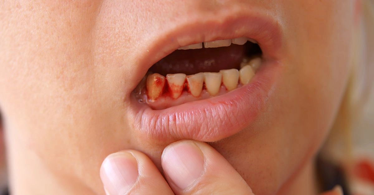 How to Identify and Treat a Cut on the Gums