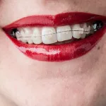 Damon Braces: How They Compare to Other Teeth-Straightening Devices