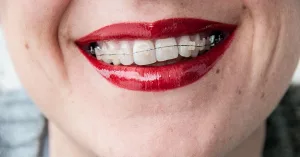 Damon Braces: How They Compare to Other Teeth-Straightening Devices