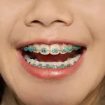 What Purpose Do Elastics (Rubber Bands) Have for Braces? What Purpose Do Elastics (Rubber Bands) Have for Braces?