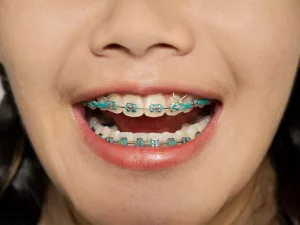 What Purpose Do Elastics (Rubber Bands) Have for Braces? What Purpose Do Elastics (Rubber Bands) Have for Braces?