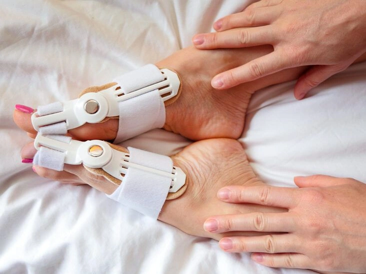 Do Bunion Correctors Actually Work to Treat Bunions and Relieve Pain?